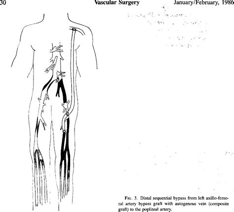 Figure 1 From Axillo Femoral Bypass Semantic Scholar