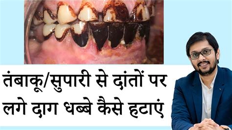 सुपारी तम्बाकू के दाग धब्बे दांतो पर से कैसे हटाएँ Teeth Whitening