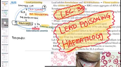 Lead Poisoning Haematology 35 First Aid Usmle Step 1 In Urdu Hindi Youtube