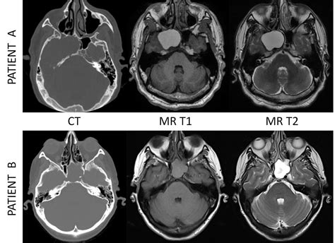 Sphenoid Sinus Mri