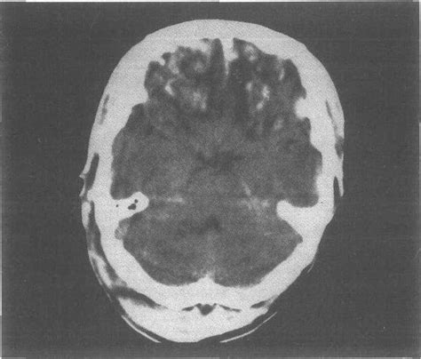 8 弥漫性脑损伤 Ct诊断图谱 医学