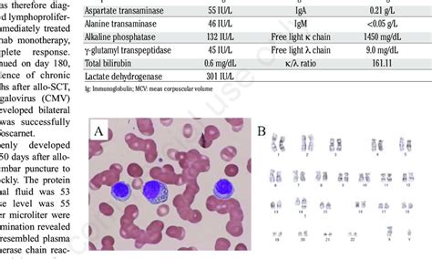 Giemsa Stained Peripheral Blood Showing Many Circulating Plasma Cells