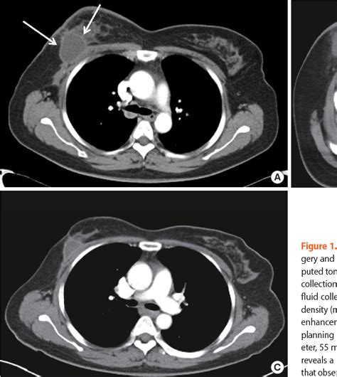 figure   computed tomographic findings  postoperative seroma