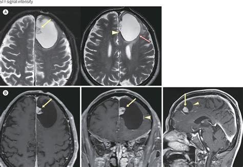 Figure From Imaging Features And Pathological Correlation In Mixed