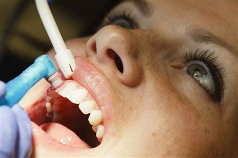 Profilaxia dentária como é feita e quais são os benefícios