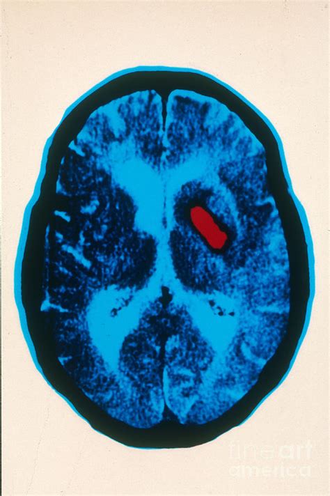 Hemorrhagic Stroke Ct Scan Photograph By Scott Camazine Fine Art America