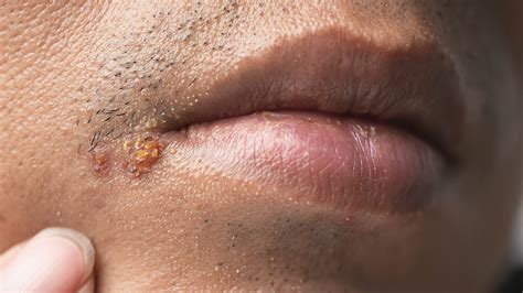 Shingles Symptoms With Pictures