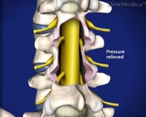 Lumbar Laminectomy - Birmingham, AL - Spine and Neurosurgery