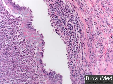 Bronchiectasis Pathology Residency And Fellowship Program Brown