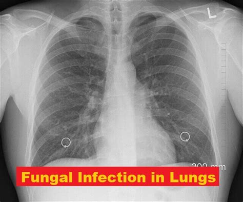 Fungal Infection In Lungs Causes Risk Factors Symptoms And 3 Diagnosis Methods