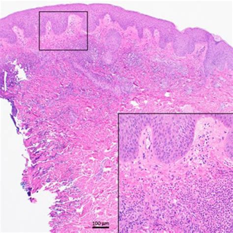 Punch Biopsy Showing Mild Epidermal Hyperplasia Above An Inflammatory