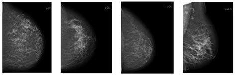 Electronics Free Full Text Detecting Breast Arterial Calcifications