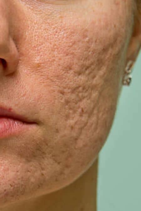 Tca Cross Treatment Acne Scarring Birmingham Chiswick London Dr