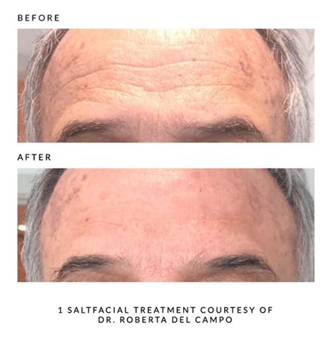 Saltfacial Henderson Med Spa Aesthetic Services In Nevada