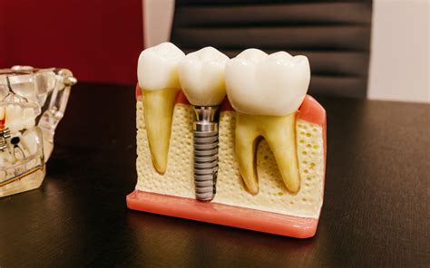 What is a dental implant abutment? - Nha Khoa Sydney