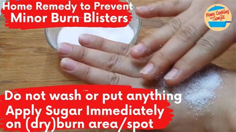 Home Remedy To Prevent Minor Burn Blisters Apply Sugar Immediately