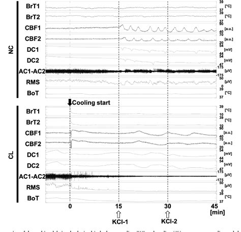 Figure From Focal Brain Cooling Suppresses Spreading Depolarization