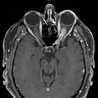 T Weighted Post Contrast Axial Magnetic Resonance Imaging Mri Of