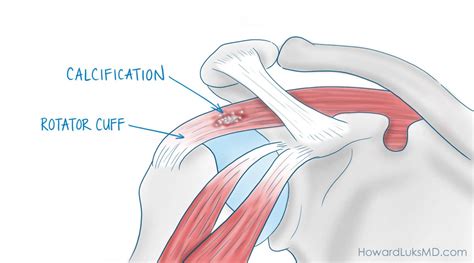 Rotator Cuff Tendonitis