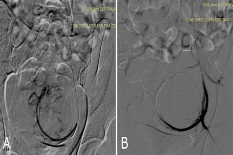 Angiographic Findings Pre And Post Embolization A Transradial Super