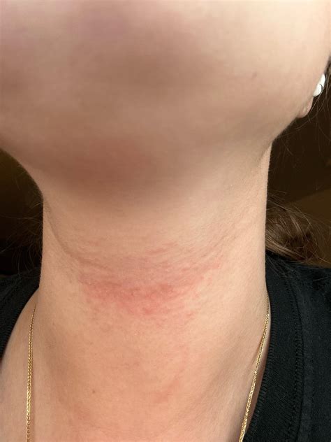 Started Getting A Rash On My Neck And Have No Idea Where It Came From Or What It Could Be R