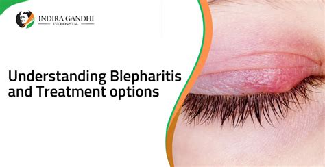 Understanding Blepharitis and Treatment options - IGEHRC