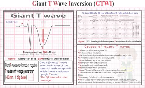 ECG Educator Blog : Giant T waves