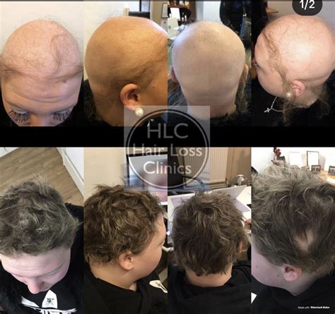 New Alopecia Treatment 2024 Aimee Atlante