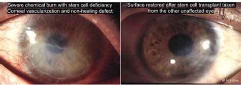 Limbal Stem Cell Transplantation