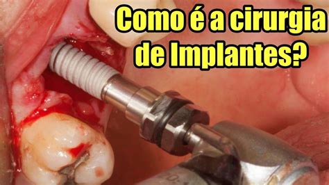 Cid Reabertura De Implante BRAINCP