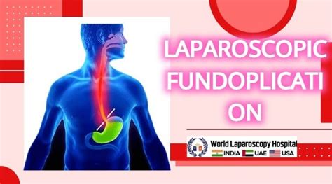 Questions About Laparoscopic Fundoplication