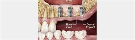 SINUS LIFTING SINUS AUGMENTATION Uğurel Diş Polikliniği