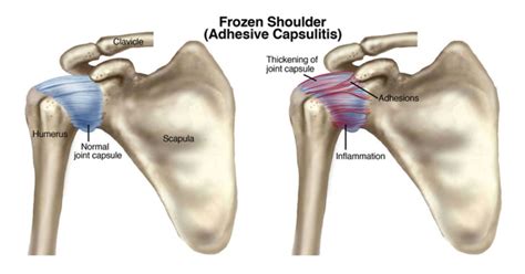 Frozen Shoulder Adhesive Capsulitis