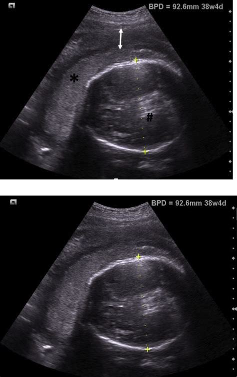 Transabdominal Ultrasound Image 1low Lying Placenta Over The Download Scientific Diagram