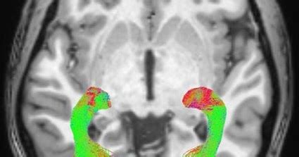 Our Parkinson S Place Brain Mri Shows Visual System Changes In