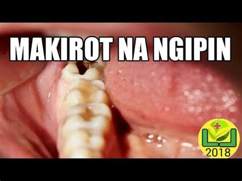 Mabisang Gamot Sa Appendix Mosop