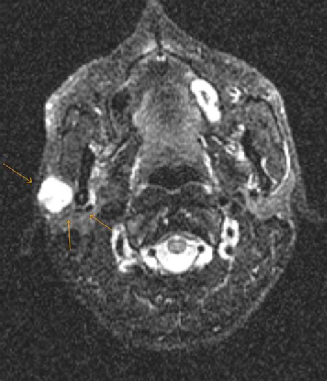 Pleomorphic Adenoma MRI Sumer S Radiology Blog