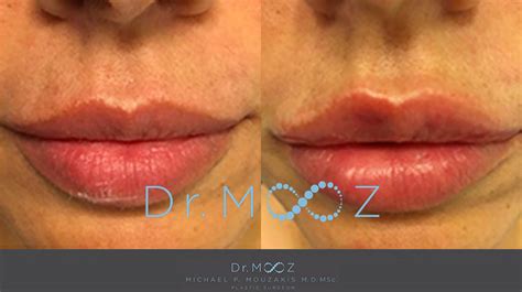 Focus On Facial Fillers London Aesthetic Injectables Dr Mooz