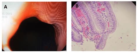 A Lower Esophagus Endoscopic View A Shows Possible Early Barretts