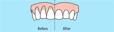 Gum Recession 2 - Clock Tower Dental