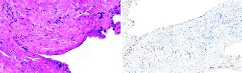 Histopathological And Immunohistochemical Analysis Of The Surgical