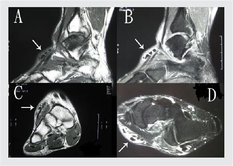 Figure From Tenosynovial Extra Articular Chondromatosis Of The