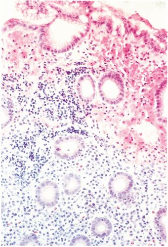 Helicobacter Pylori And Chronic Gastritis Annals Of Saudi Medicine