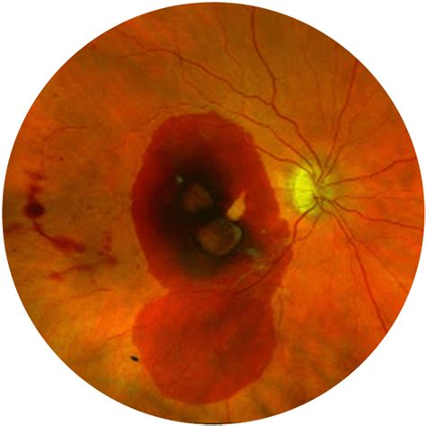 Retina Consultants Of Southern Colorado Treating Diseases Of The Retina