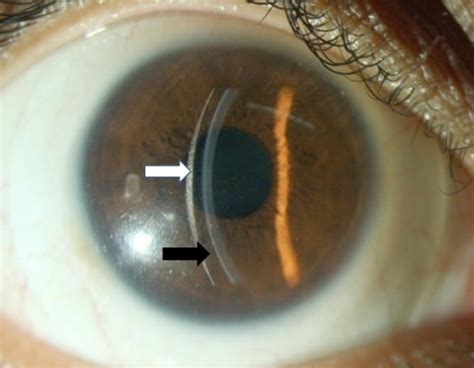 Scleral Lens For Keratoconus Technology Update Opth