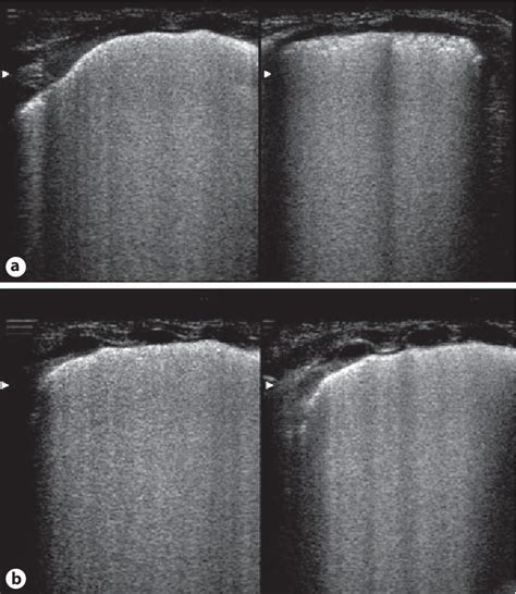 Figure 1 From Lung Ultrasound In Respiratory Distress Syndrome A Useful Tool For Early