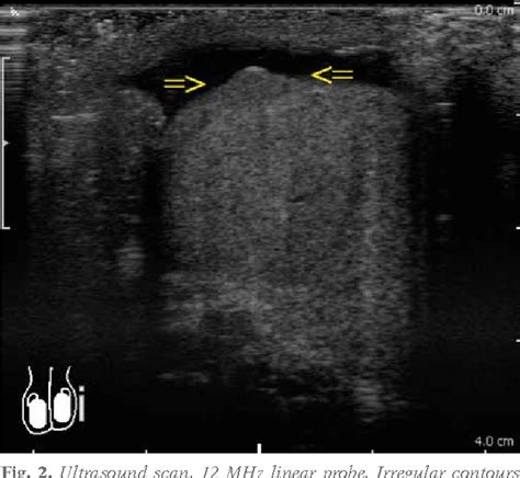 Figure 2 From Capillary Hemangioma Of The Testis A Case Report Of A