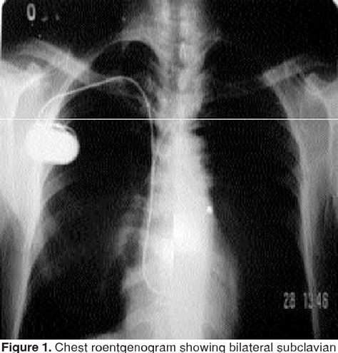 Figure From Two Stage Surgical Treatment Of Infected Pacemaker Leads