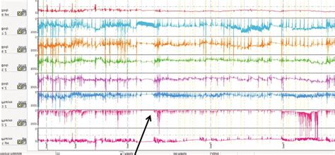 Simultaneous Evaluation Of Laryngopharyngeal Reflux And Swallowing