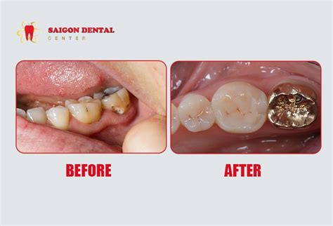 Gold Dental Crown Benefits Procedure Cost Saigon Dental Clinic